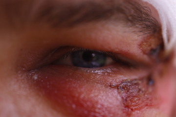 Close up of swollen eye after an accident with scars
