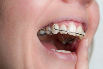 Obraz premium Zahnspange wird eingesetzt