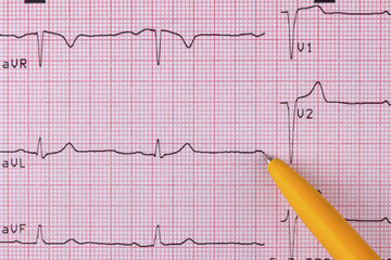 Electrocardiogram