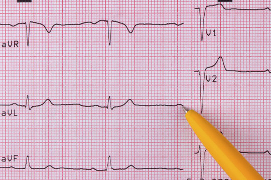 Electrocardiogram