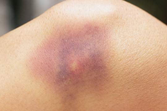 Bluterguss am Knie