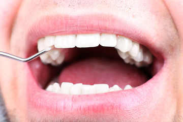 Examine of man by dentist with dental mirror, macro view