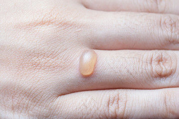 Blister on Human Finger