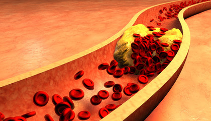 Clogged Artery with platelets and cholesterol plaque - 79614751