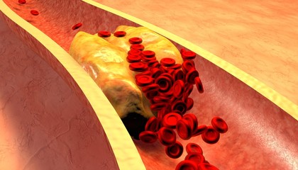 Clogged Artery with platelets and cholesterol plaque