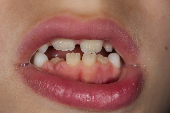 The child is teething