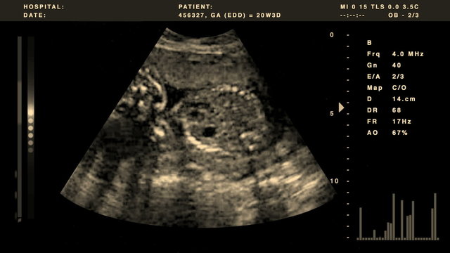 Video out put from an ultrasound combined with graphics.