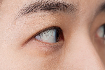 Fototapeta premium Eye injury or infected for healthy concept, macro closeup