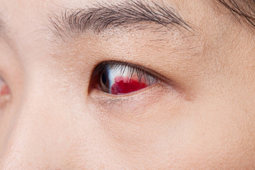 Eye injury or infected for healthy concept, macro closeup