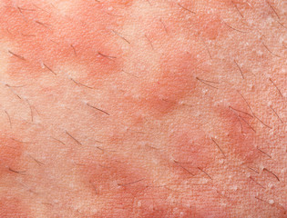 Eczema atopic dermatitis
