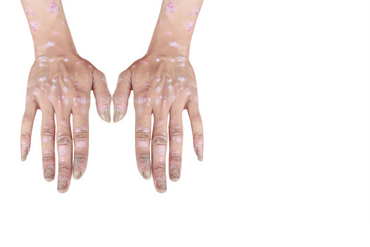Psoriasis on the palms, fingers and nails of an adult male