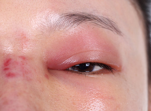 close-up of upper eye lid swell after nose job