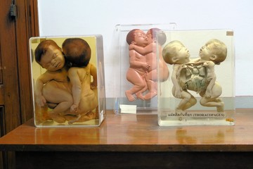 Conjoined Twins Forensic Exhibit