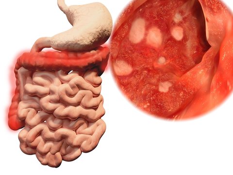 Vorkommen der colitis ulcerosa im Gastrointestinaltrakt