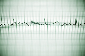 Electrocardiogram