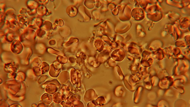 Blood Thickening 600x