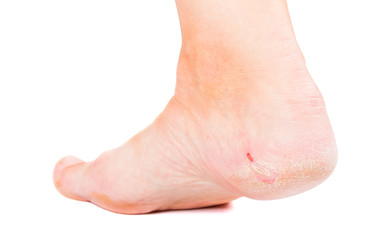 Dry skin on heel