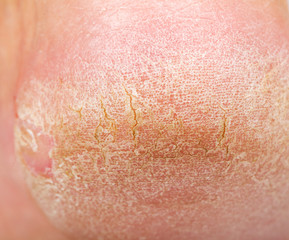Dry skin on heel