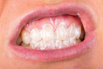 Obraz premium Teeth cleaning