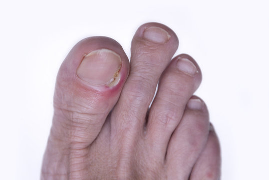 Inflammation of the nail of the big toe