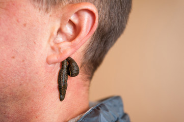 Leech therapy for a man