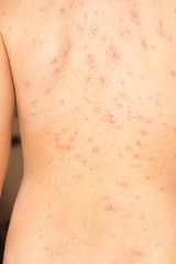 Detail baby with chicken pox rash