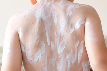 Detail baby with chicken pox rash