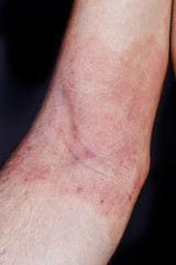 skin dermatitis
