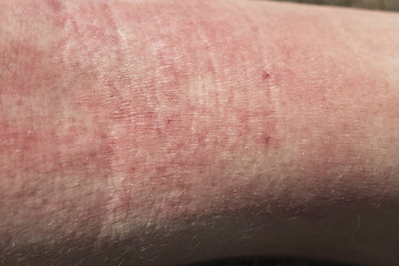 skin dermatitis