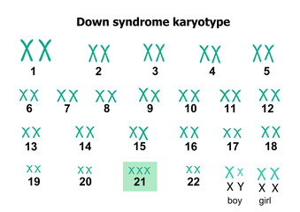 Down syndrome karyotype