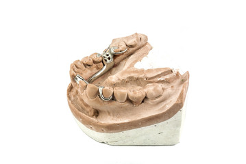 Dental cast with metal framework for partial denture