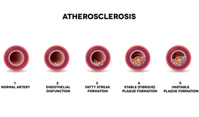 Atherosclerosis formation. Healthy artery and unhealthy arteries