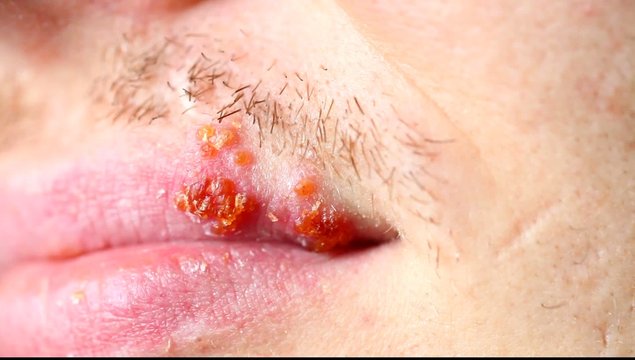video herpes on the lip men