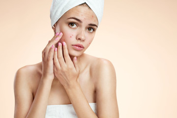 Teenage girl squeezing her pimples