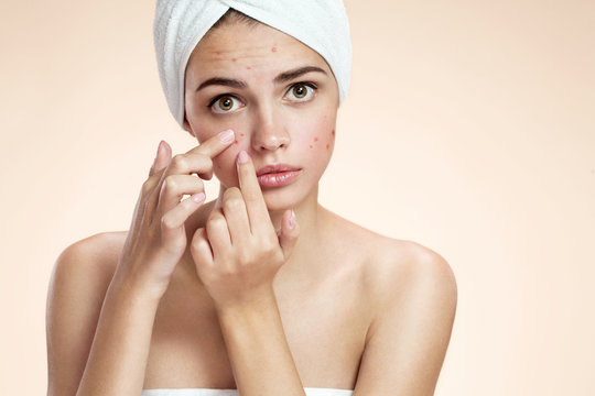 Acne spot pimple spot skincare beauty care girl