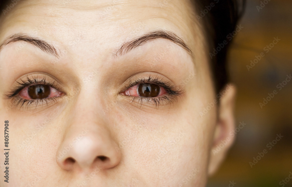 Wall mural sick woman's eyes