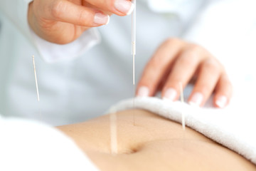 Acercamiento de las manos de una doctora aplicando un tratamiento de acupuntura en el abdomen de una paciente - obrazy, fototapety, plakaty