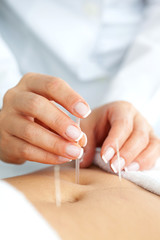 Acercamiento de las manos de una doctora llevando a cabo un tratamiento de acupuntura en el abdomen de una paciente - obrazy, fototapety, plakaty