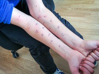 Allergy skin test on the arms of a boy