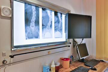 Röntgenaufnahmen der Wirbelsäule mit Skoliose beim Orthopäden