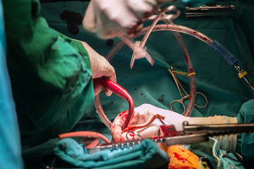 coronary artery bypass grafting