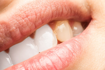 Woman Teeth Before And After Dentist Whitening Procedure Macro