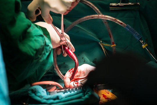 coronary artery bypass grafting