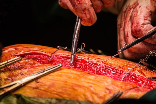 closure sternum bone with metal wires