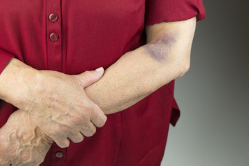 Large hematoma on human arm