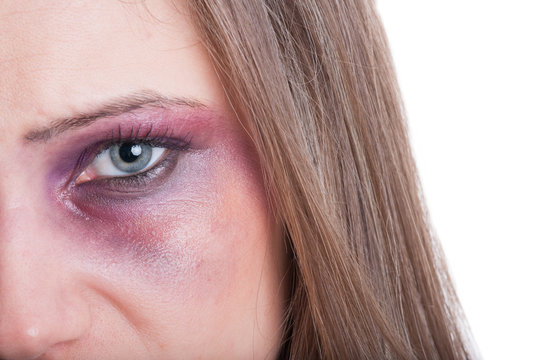 Black or bruised woman eye