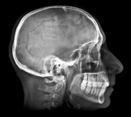 Human skull X-ray image