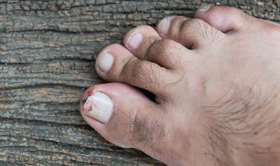 Broken toenail on wood background