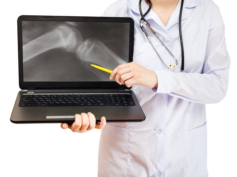 nurse points on computer laptop with knee joint
