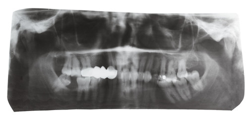 dental X-ray picture of human jaws isolated
